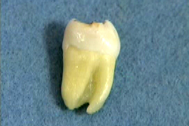 縁下歯石のない歯